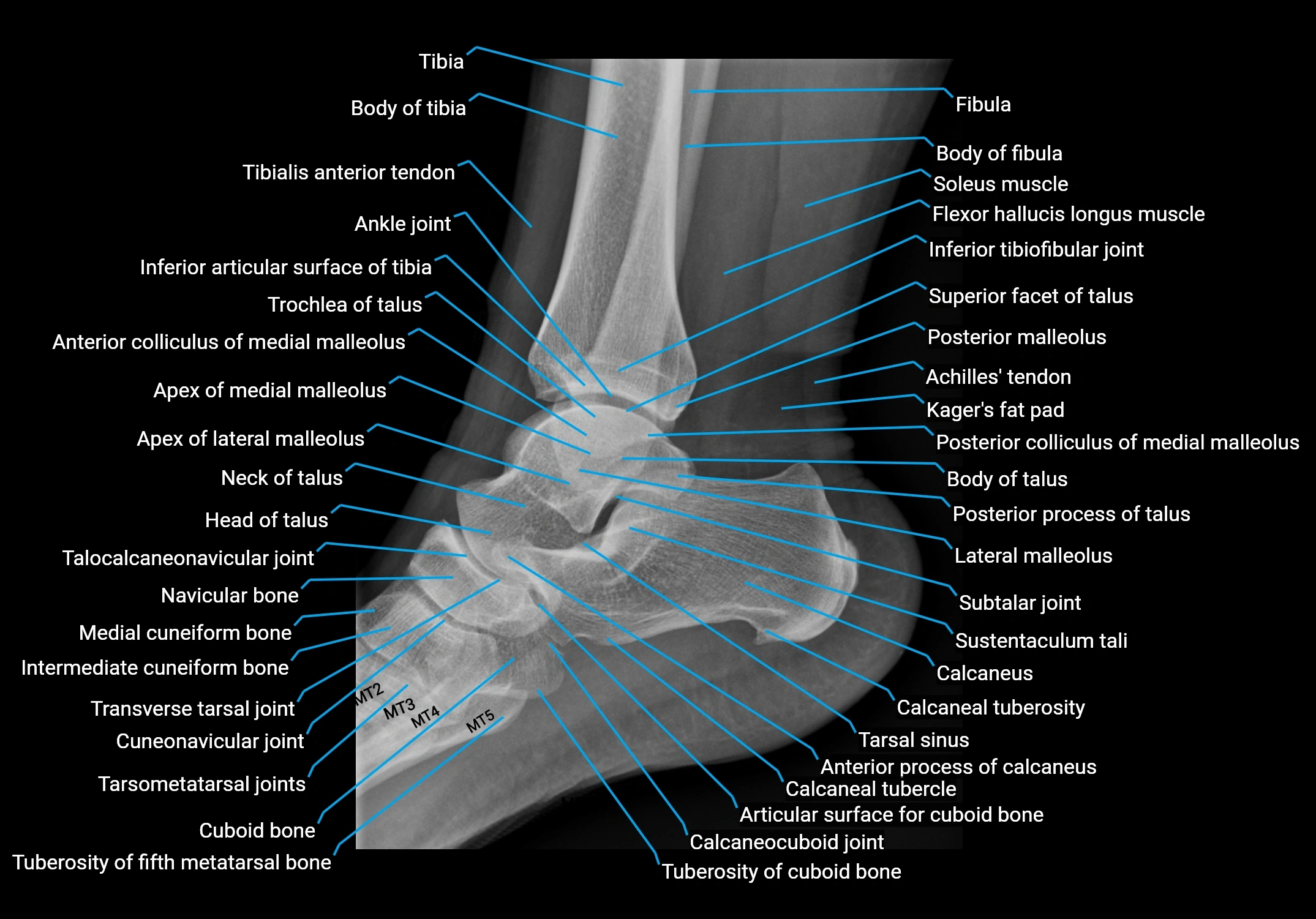 X Ray ankle LAT anatomy.webp
